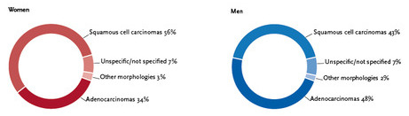 Distribution of malignant neoplasms ot the oesophagus by histological type and sex, ICD-10 C15, Germany 2015–2016. Source: © German Centre for Cancer Registry Data at the Robert Koch Institute